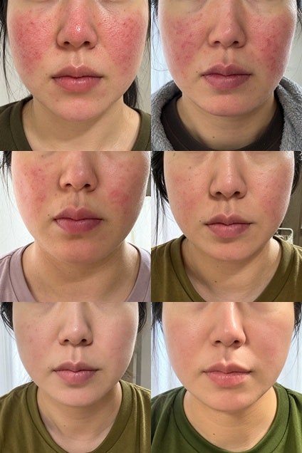 주사피부염 5개월 치료 기록과 효과적인 홈케어 관리 노하우 3가지