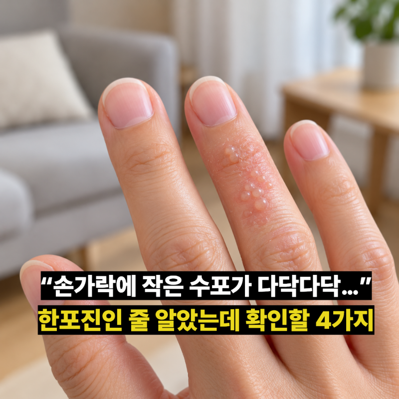 “손가락에 작은 수포가 다닥다닥…” 한포진인 줄 알았는데 확인할 4가지