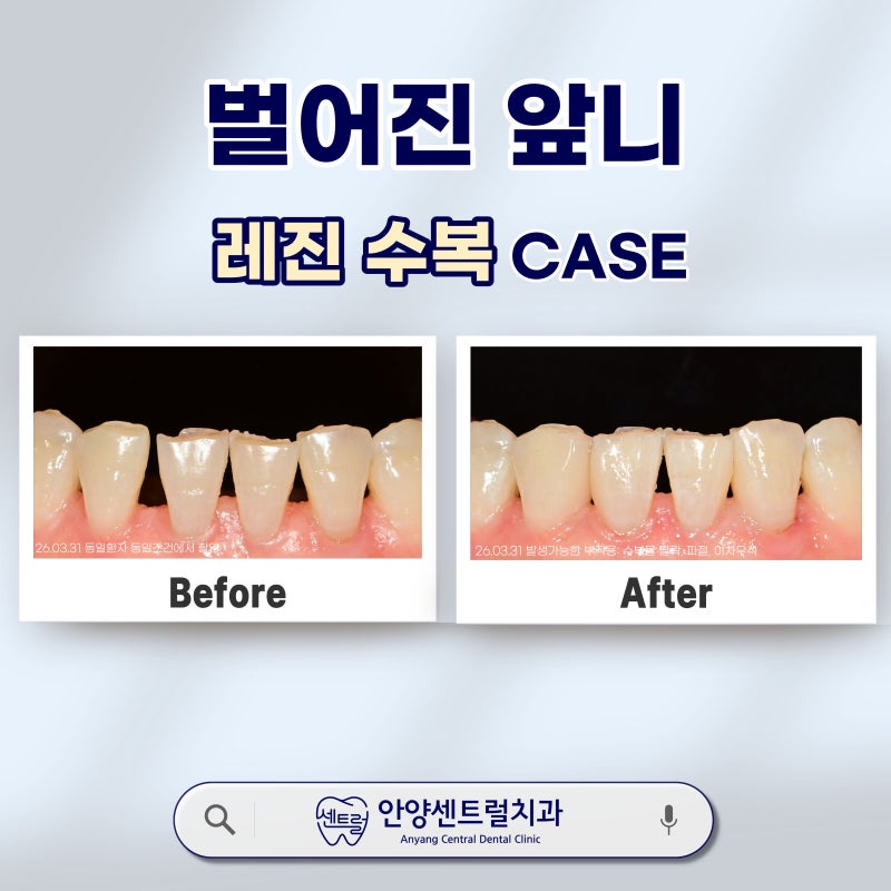 벌어진 앞니 레진 치료, 치아 삭제 없이 당일 개선한 사례