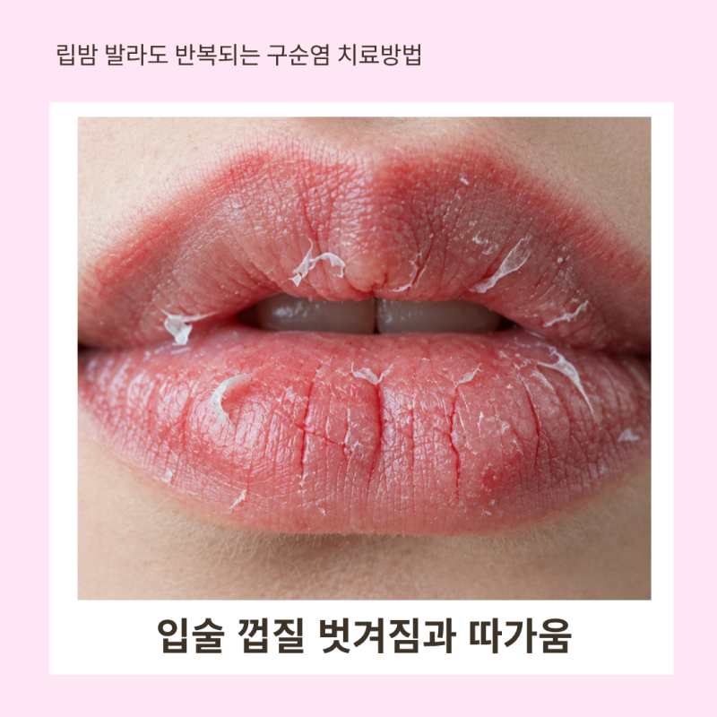입술 껍질 벗겨짐과 따가움, 립밤 발라도 반복되는 구순염 치료방법