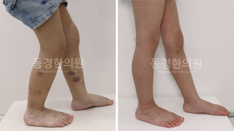 발목 자반증 증상과 병원 가기 전 자가 진단 테스트