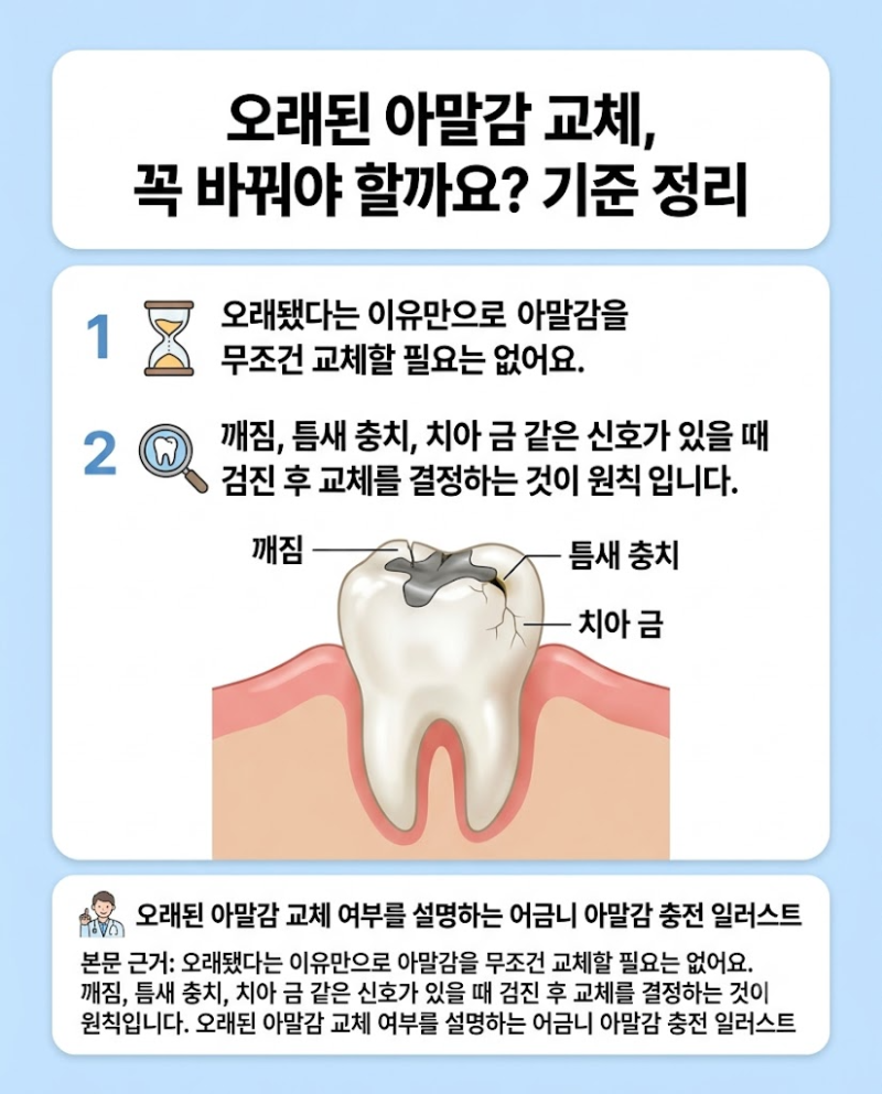 대구 대명자이치과, 오래된 아말감 교체, 꼭 바꿔야 할까요? 기준 정리