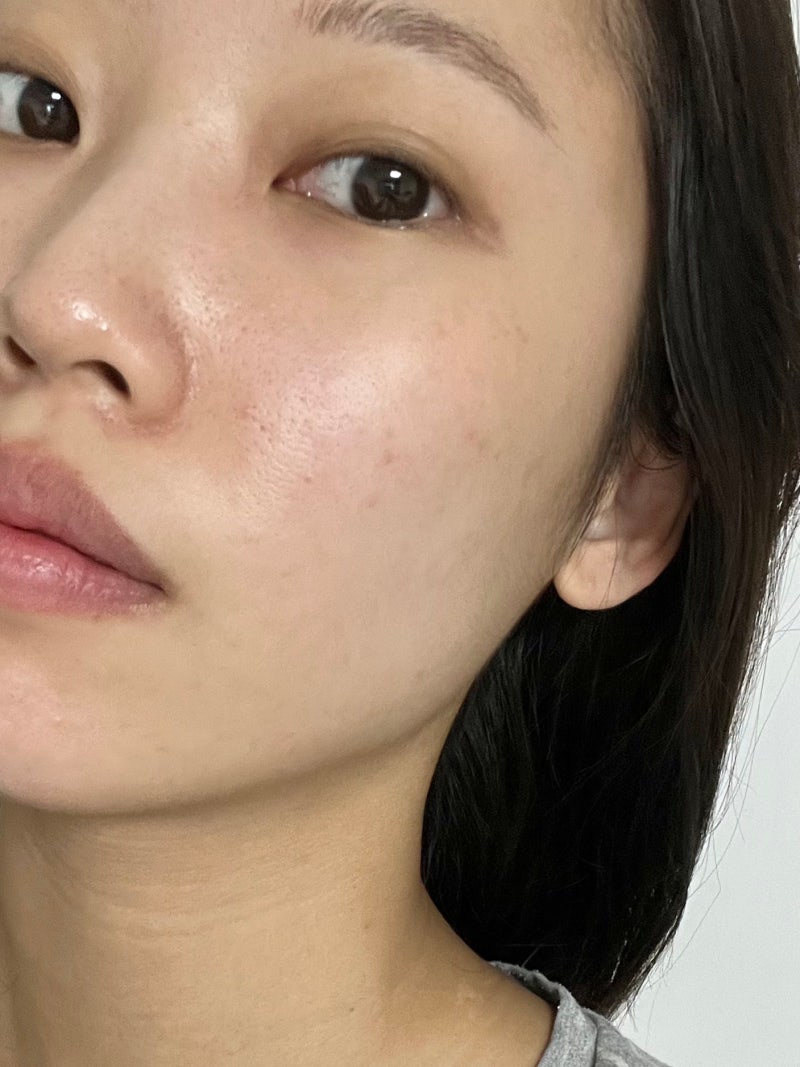 수원시청역 피코슈어 피코토닝레이저 효과, 기미 잡티 1회차 후기