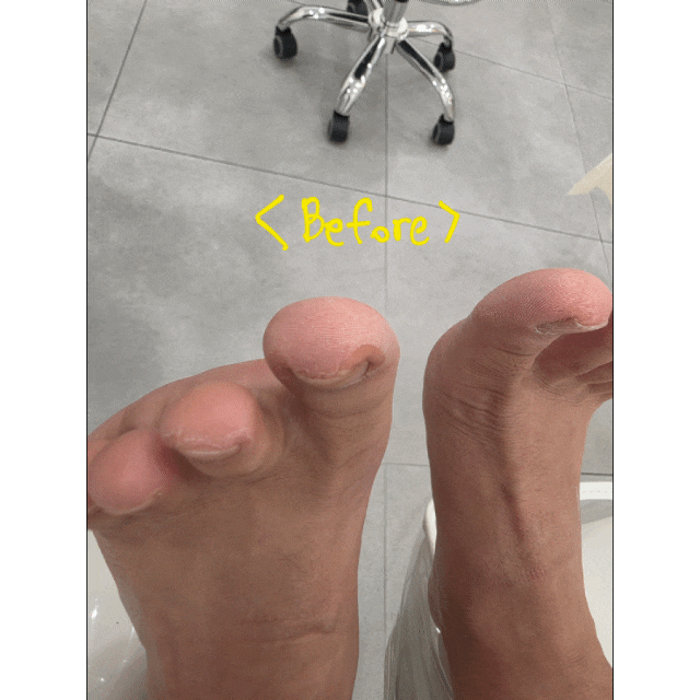 내성발톱에 대한 오해와 진실: 제로 문제성 발톱 클리닉 (하남 내성발톱 교정)