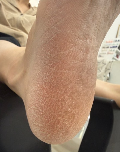 안산 발각질, 뒤꿈치가 건조하고 갈라진다면 얼마나 제거해야 할까요?