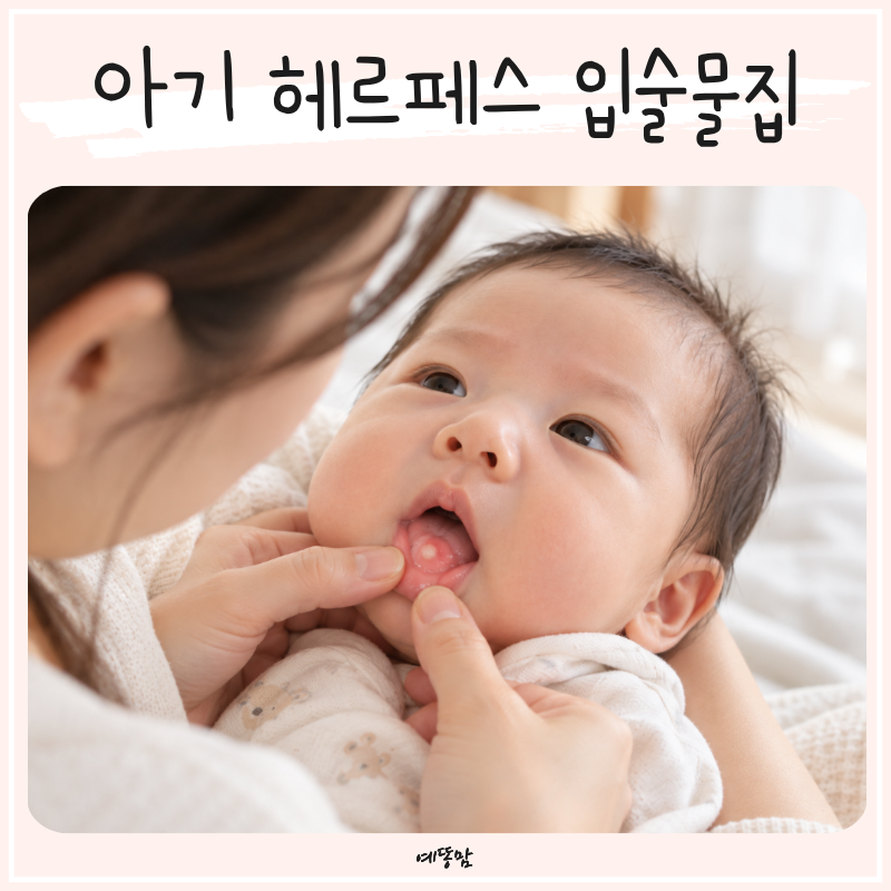 신생아 입술물집 원인부터 증상까지, 아기 헤르페스 입안 수포도 전염될까?