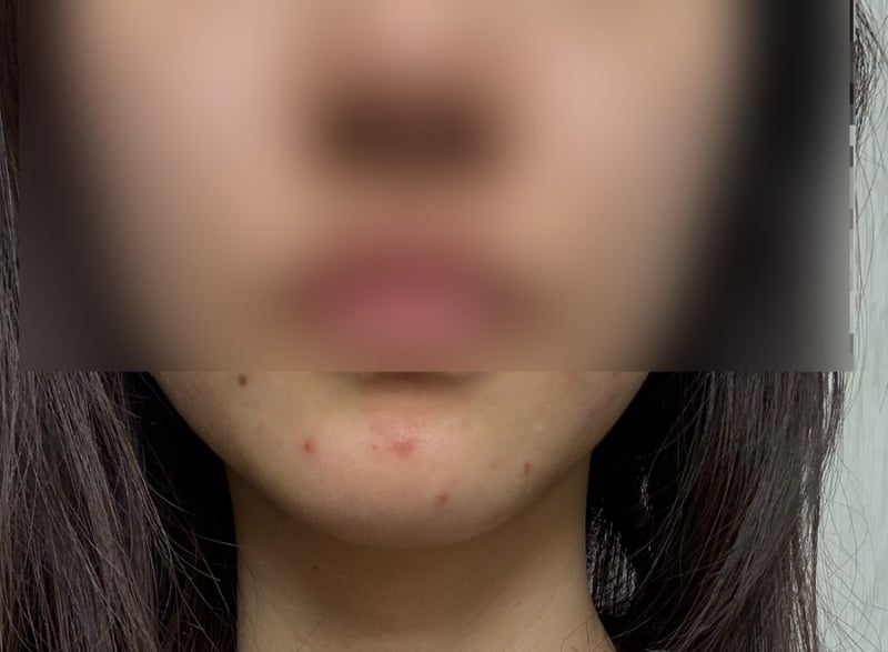 딱딱하고 아팠던 여드름, 결국 염증주사 맞아본 후기｜2주 후 상태