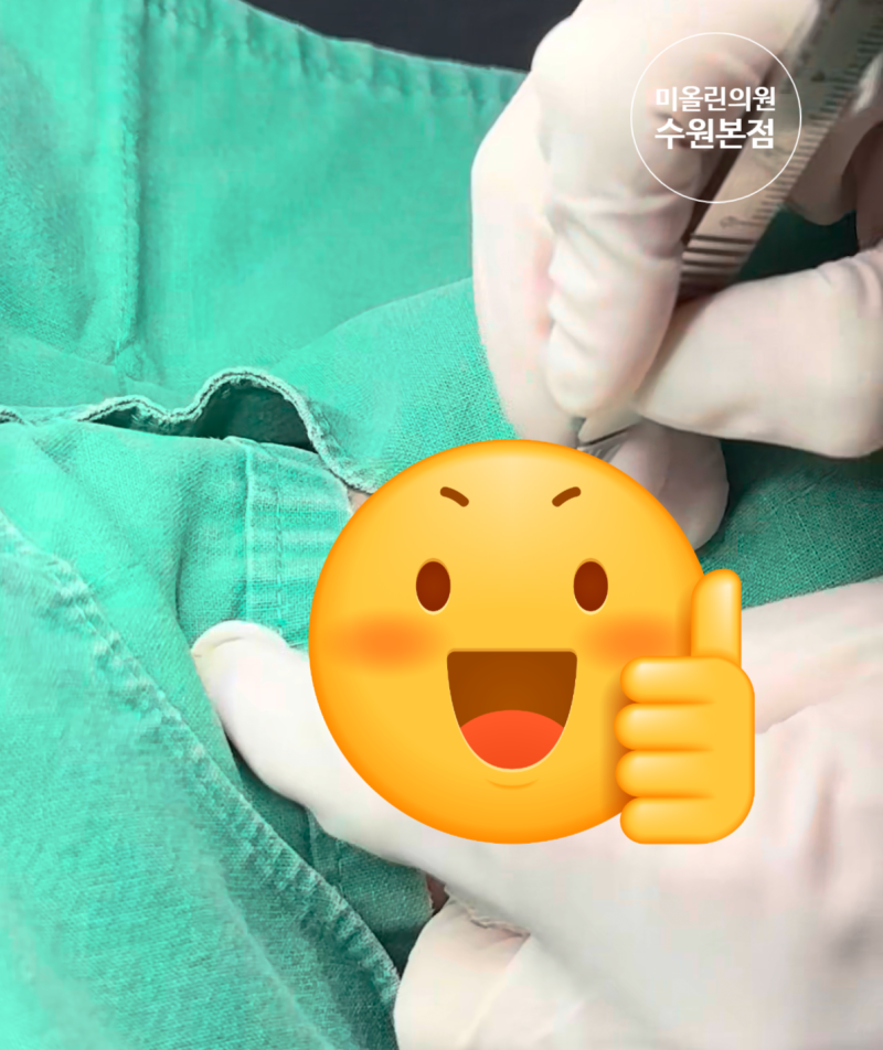 수원 피지낭종 제거, 짜도 다시 생기는 이유와 수술이 필요한 경우