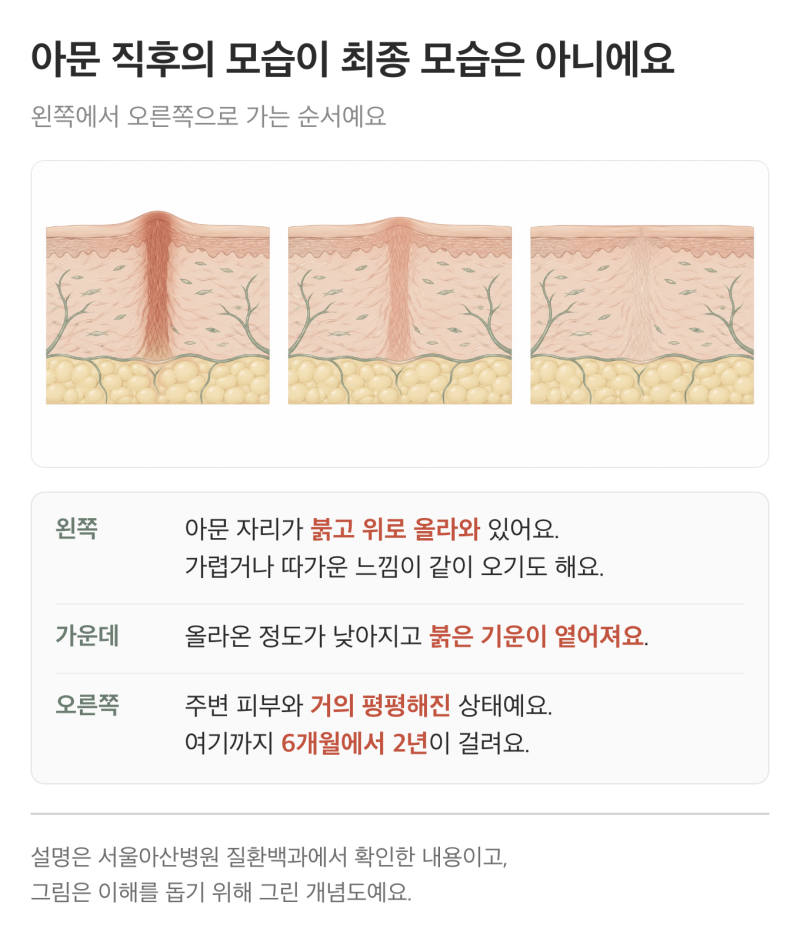 켈로이드 비후흉터 차이, 튀어나온 흉터 기다려도 될까?