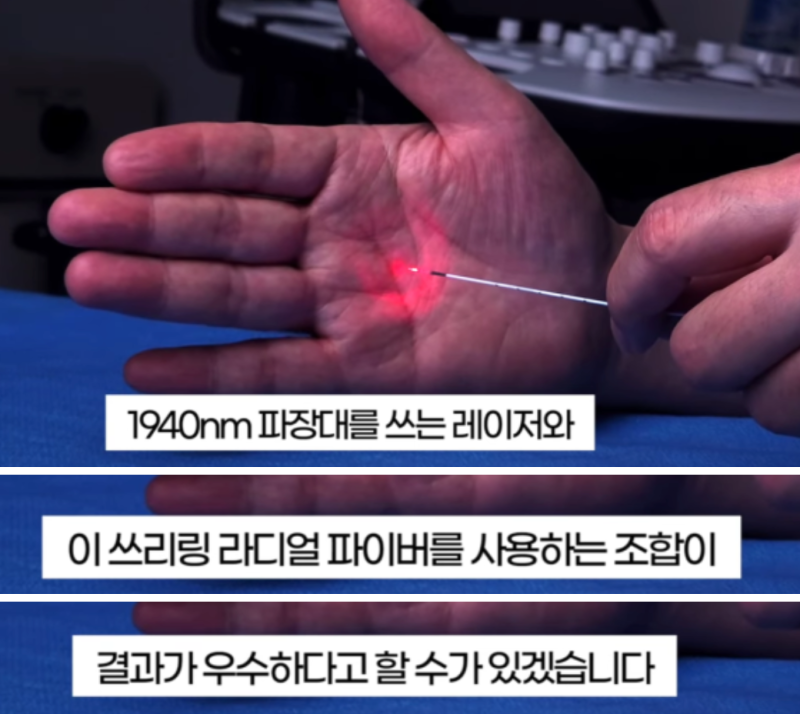 하지정맥류 레이저 수술, 같은 수술인데 통증이 다른 이유