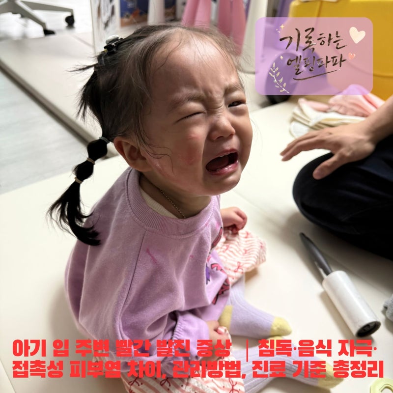 아기 입 주변 빨간 발진 증상｜침독·음식 자극·접촉성 피부염 차이, 관리방법, 진료 기준 총....