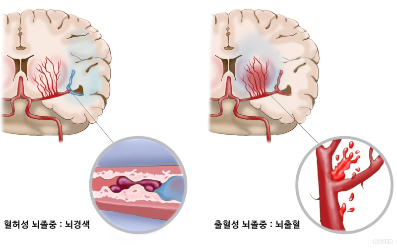 중풍(뇌졸증)