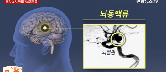 "어? 머리가 왜 이러지?" 방심하다 큰일 나는 뇌동맥류 초기증상 5가지 (골든타임 지키는 법)