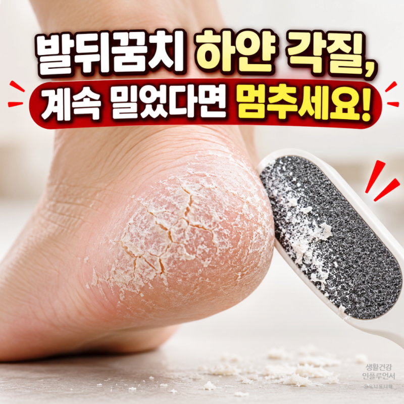발뒤꿈치 각질인 줄 알았는데 각화형 무좀? 절대 긁어내면 안 되는 이유