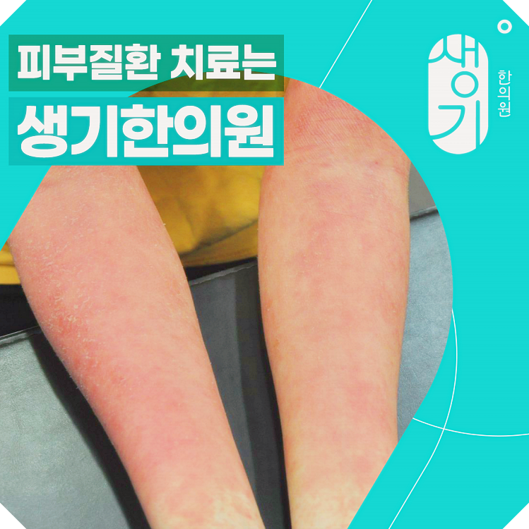 엄지손가락 사마귀 원인, 유독 같은 부위에 생기는 이유는?