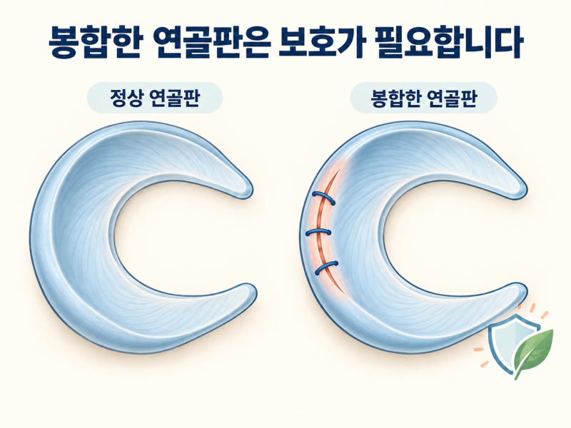 반월상 연골판 봉합술 후 회복 기간, 언제부터 걷고 운동할 수 있을까요?