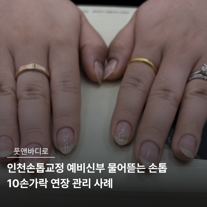 인천손톱교정 예비신부 물어뜯는 손톱 10손가락 연장 관리 사례