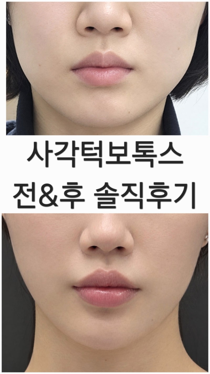 사각턱보톡스 후기 4~5년째 꾸준히 맞아본 솔직 후기!얼굴 윤곽관리 제오민, 코어톡스 턱보톡....