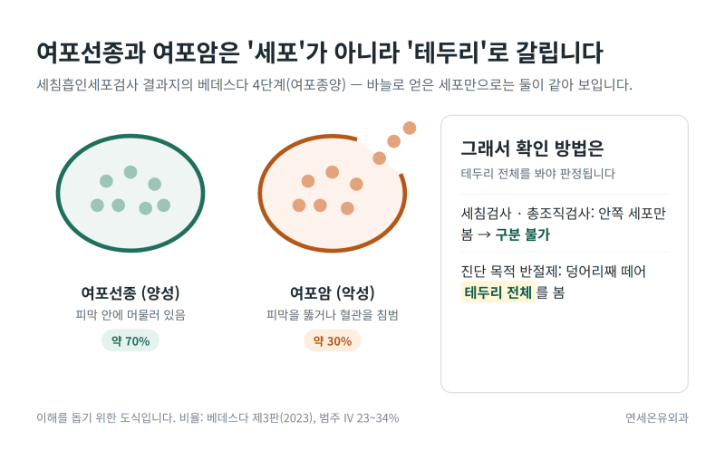 [인천 갑상선] 갑상선여포성종양(베데스다 4단계)