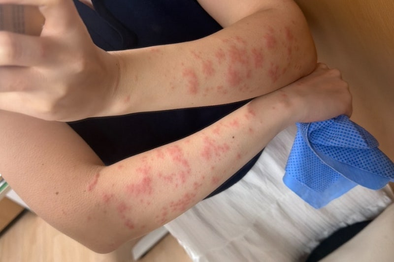 레이저 제모 후 알러지 폭발한 후기(사진주의)