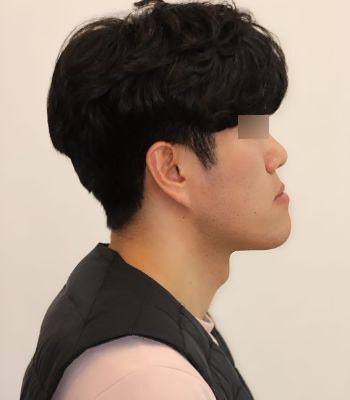 양악 수술 포기 후, 주걱턱 교정 3년 해보니..