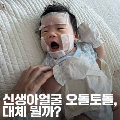 신생아 얼굴에 오돌토돌, 비립종 좁쌀여드름 그냥 둬도 될까?