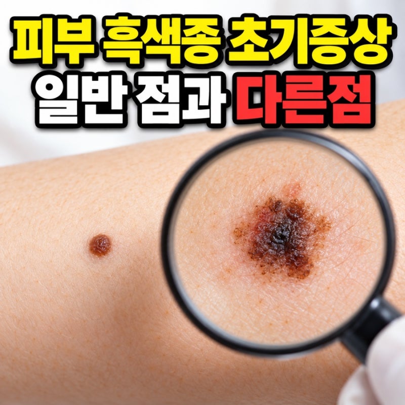 피부 흑색종 초기 증상 진단 평범한 점과 무엇이 다를까요?