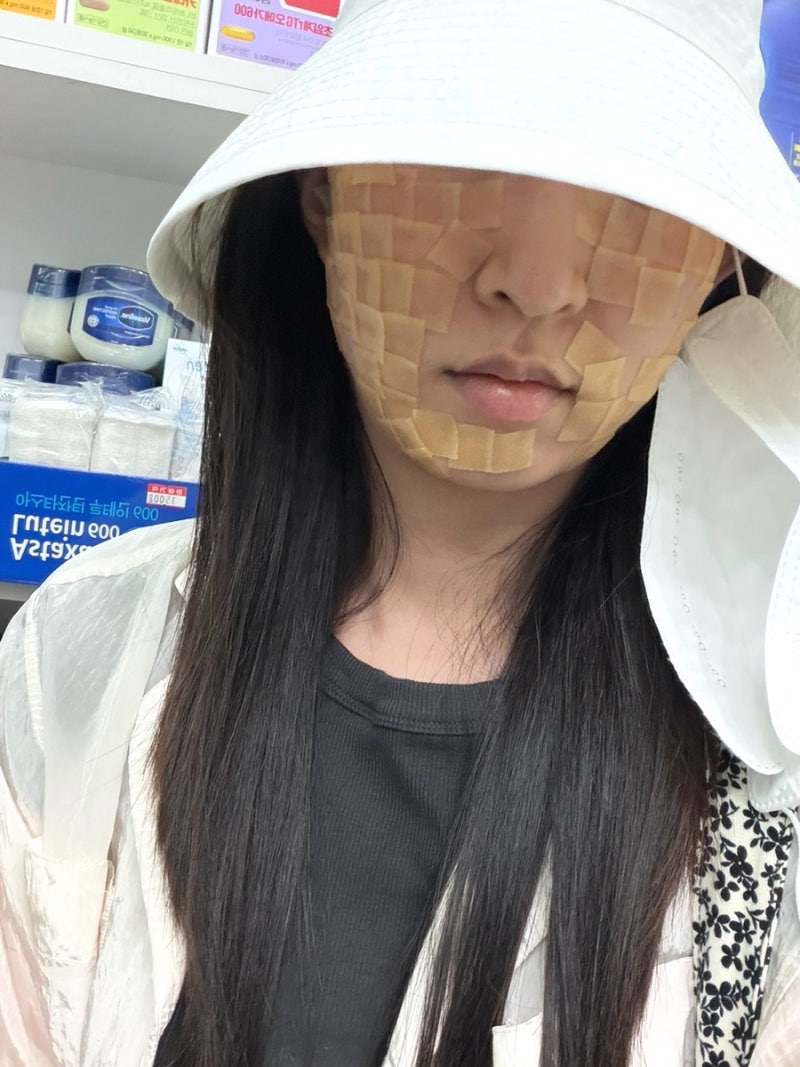 편평사마귀 제거 후기 1일차부터 일주일간 회복 과정 기록