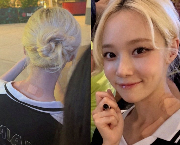 에스파 윈터 대상포진, 25세 아이돌이 겪은 진짜 속사정