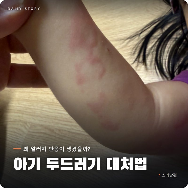 아기 알러지 두드러기 대처법