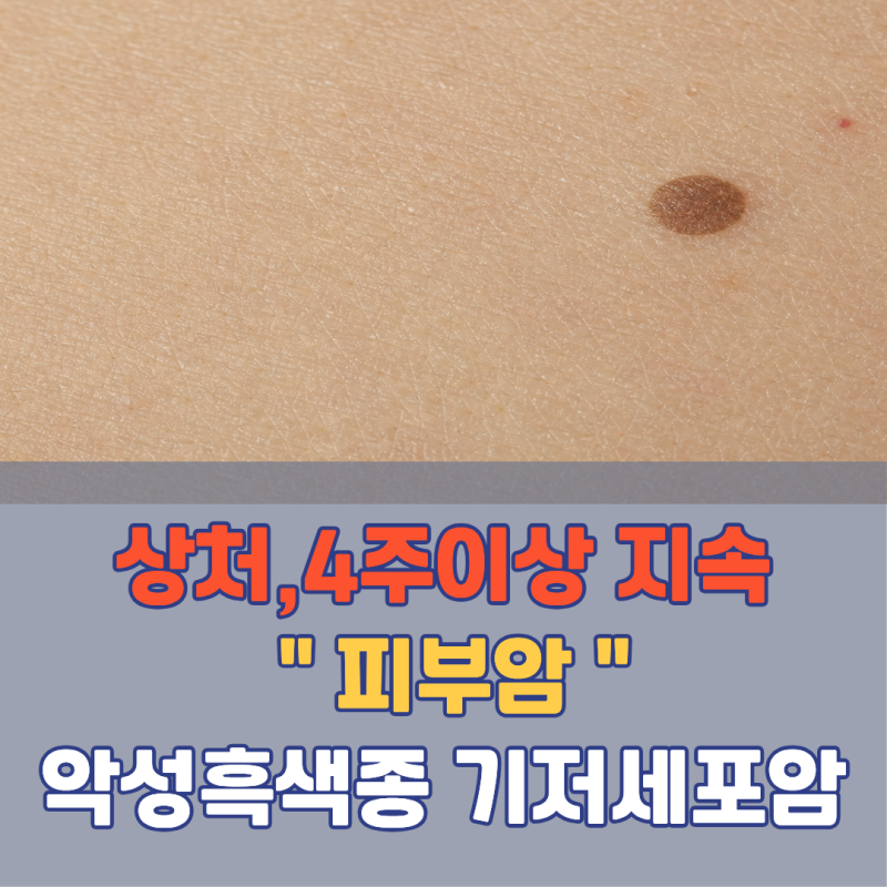 이 상처가 4주 넘게 안 아물면 피부암일 수도 있습니다! 피부암 초기증상 | 기저세포암 악성....