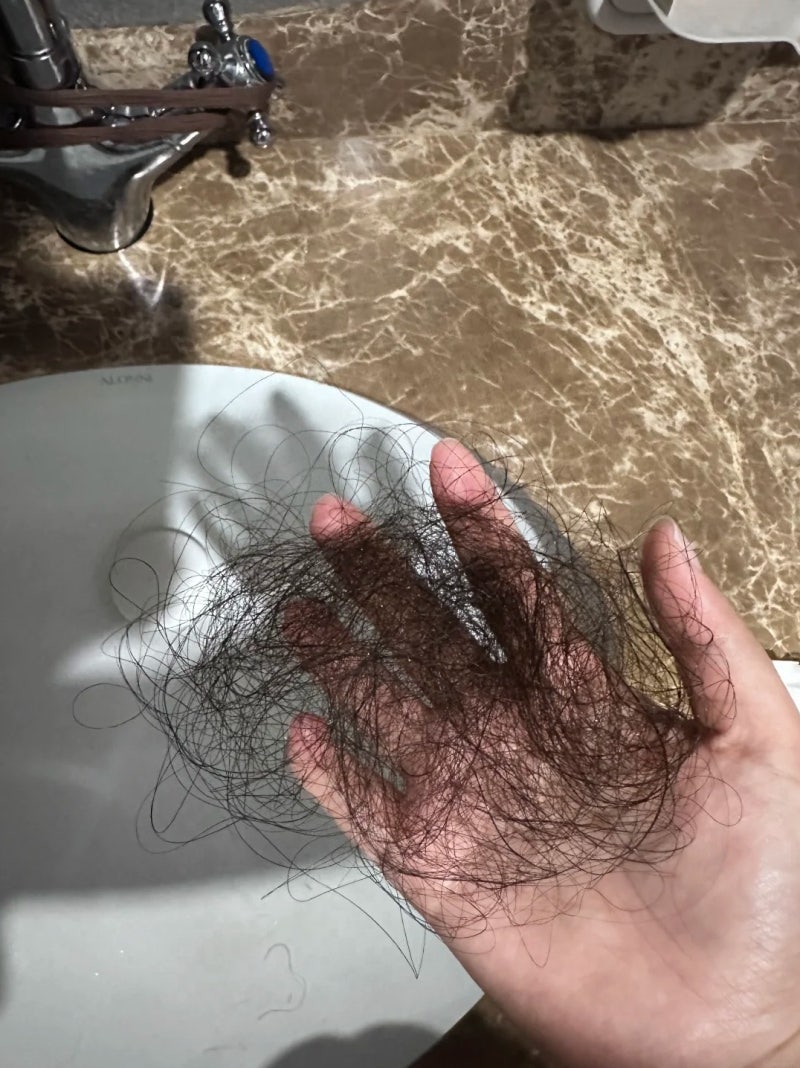 일산탈모병원 상담 전에 먼저 써본 헤어프리모 내돈내산 후기