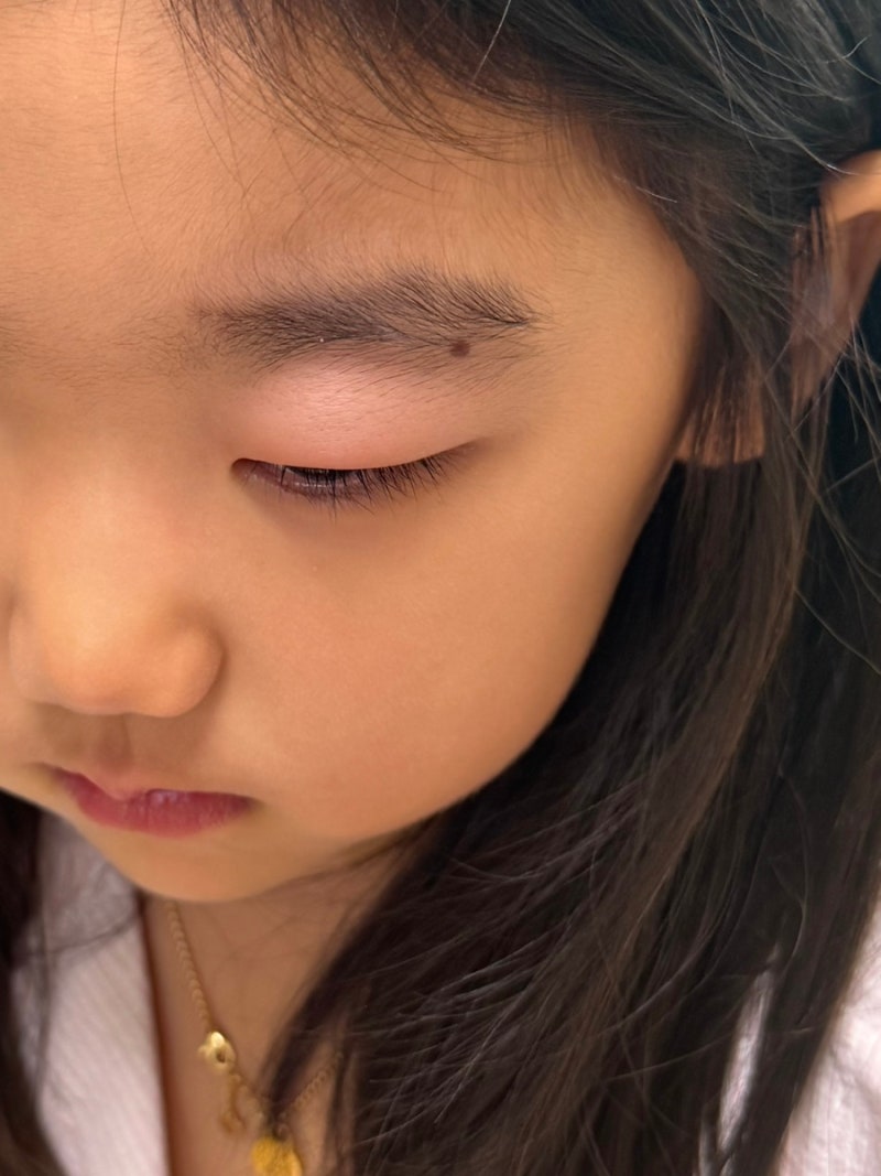 [6세 아이 다래끼] 소아과? 안과? / 다래끼 약, 고름, 온찜질, 전염은 X