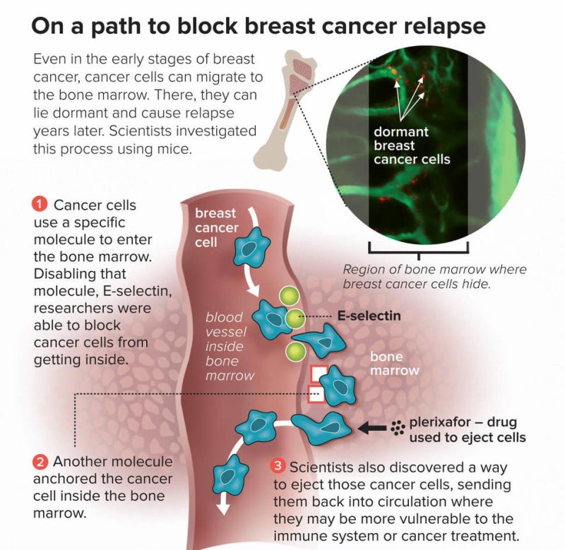 유방암 Breast cancer: 의료진·병원·연구 디렉토리