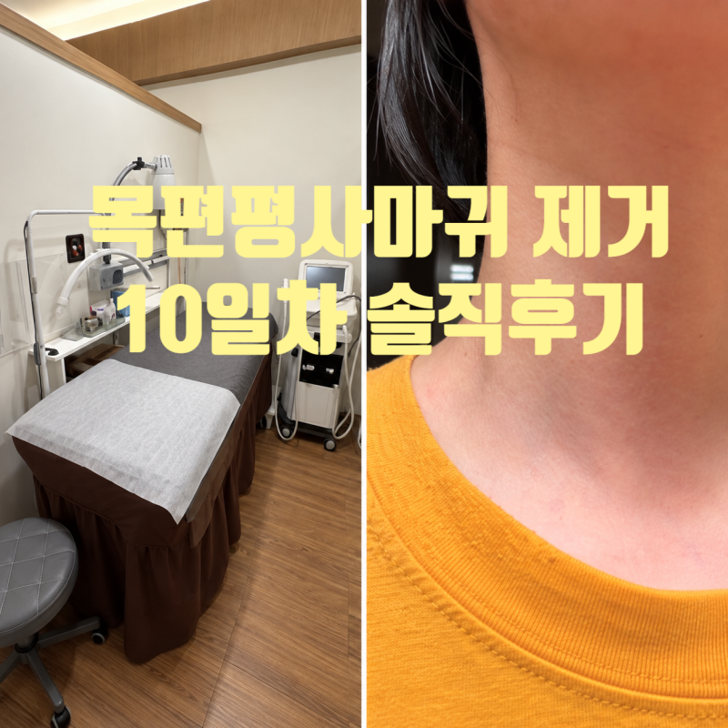 [내돈내산]목편평사마귀무제한제거후기 서울편사성지 10일간 기록