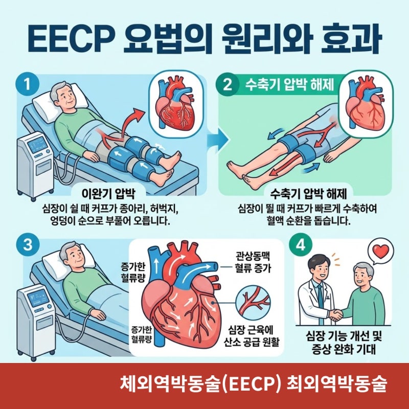 체외역박동술(EECP) 최외역박동술, 협심증 치료?