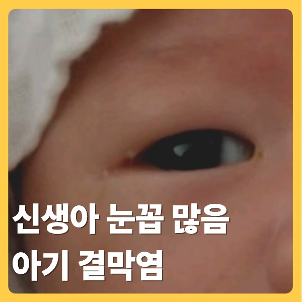 신생아 눈꼽 많음 관리법, 식염수 안약 닦는 방법과 마사지까지 (아기 결막염 후기를 곁들인)
