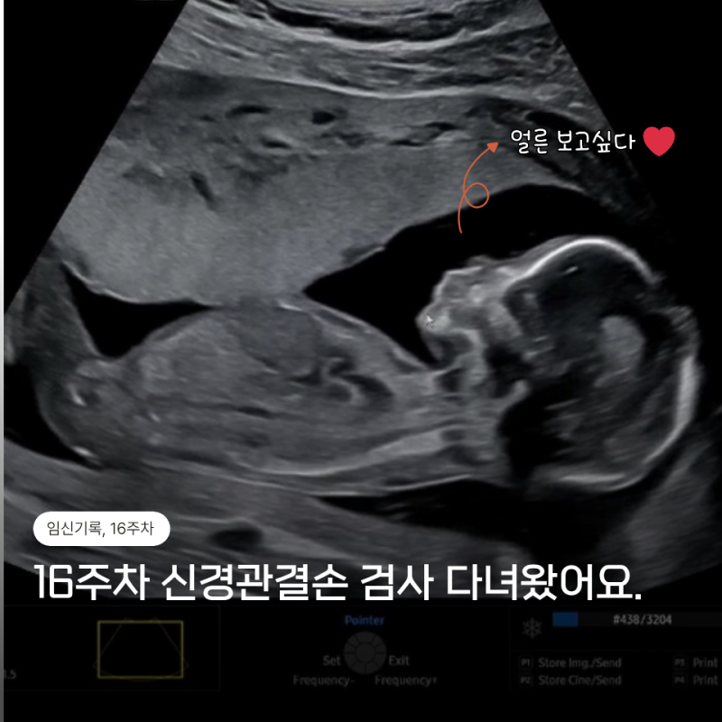 임신 16주차 김건우산부인과 신경관결손검사 후기(아기크기, 심장박동수, 무게)