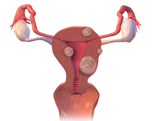 30대 자궁근종 8cm 다빈치로봇수술후기 1편 ㅡ 자궁근종 발견부터 서울성모병원 첫 진료 및 수....