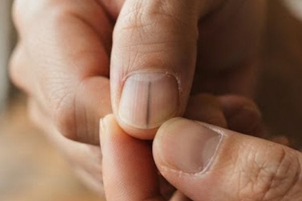 "병원 가기 전에 이것부터 드세요" 손톱 검은 세로줄 지우는 특급 식단