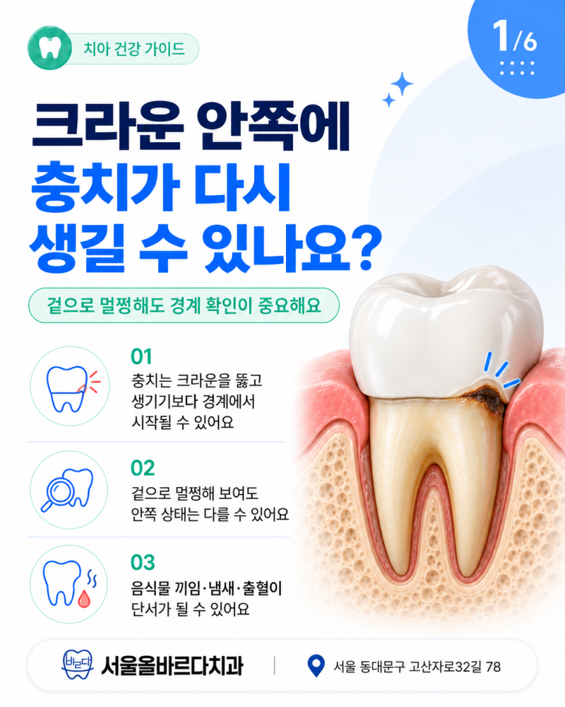 강동구치과 보철치료, 크라운 안쪽에도 충치가 다시 생길 수 있을까요 겉으로 멀쩡한 크라운....