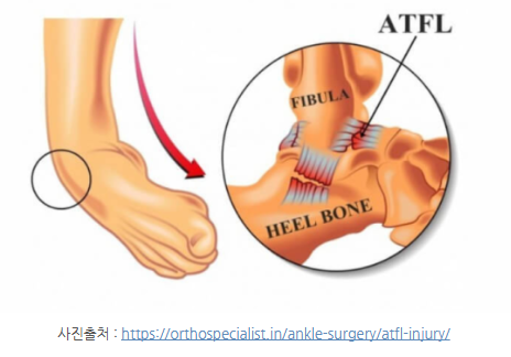 발목 인대가 끊어졌다고요? 저는 일단 수술 안 합니다.