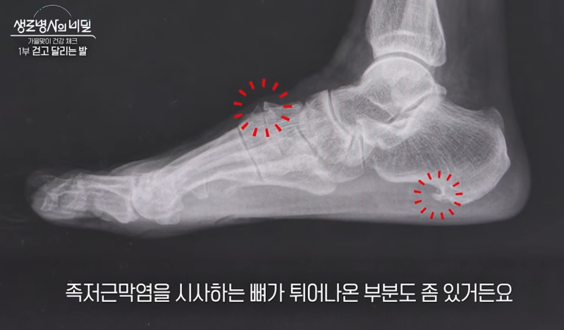발바닥 아치 통증, 족저근막염 초기증상 5가지
