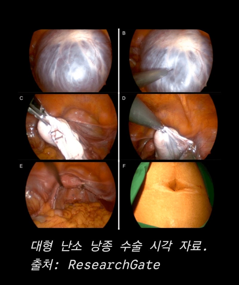 3년 전 난소 절제, 8cm진단,실제10cm 혹의 발견, 무증상의 경고,