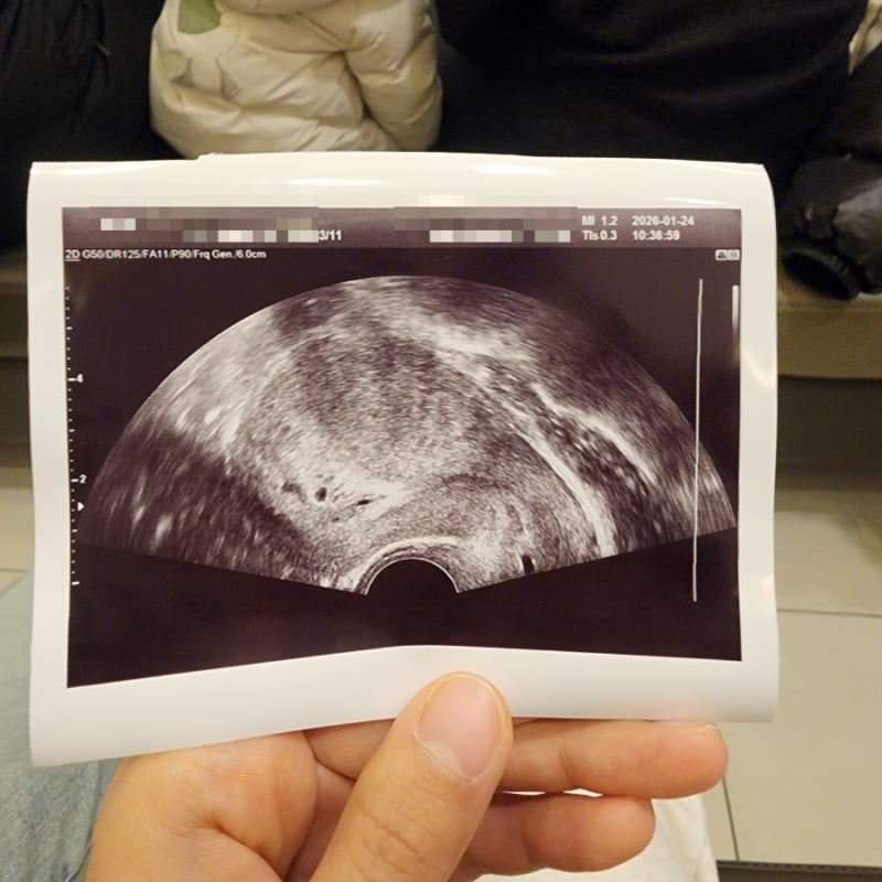 난자채취 후 시험관 휴식 중 자연임신 (feat. 고사난자 계류유산 소파술)