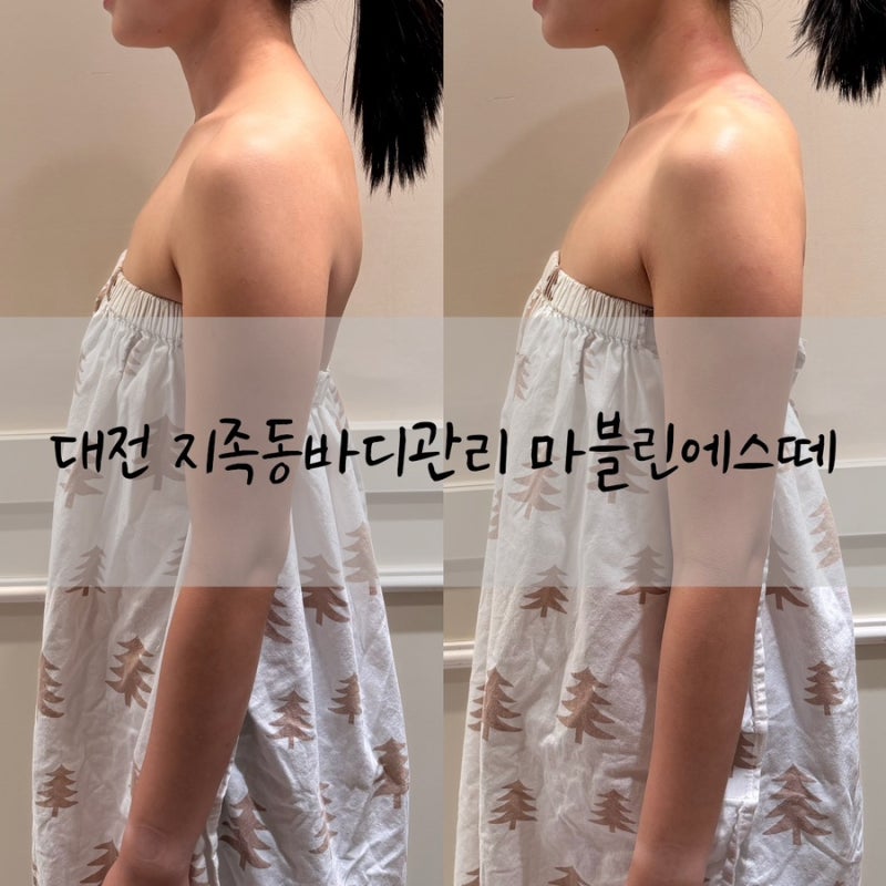 대전 지족동바디관리 라운드숄더 관리 후기 마블린에스떼