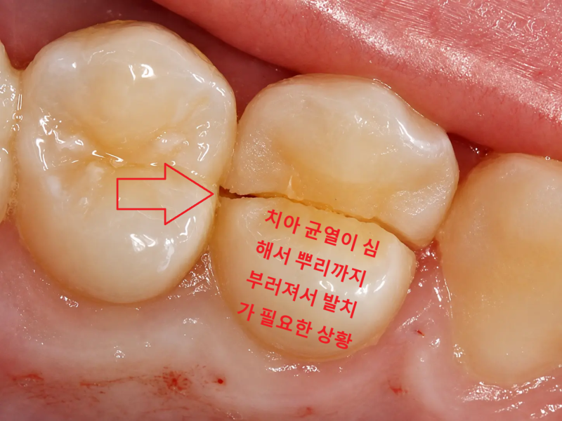 씹을 때마다 찌릿한 통증? 치아 균열 증후군 원인과 치료법