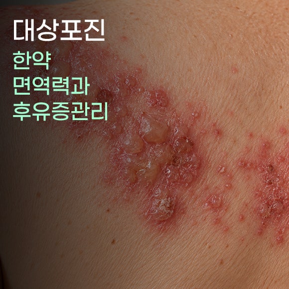 대상포진한약 면역력과 후유증 관리를 위해 살펴야 할 것