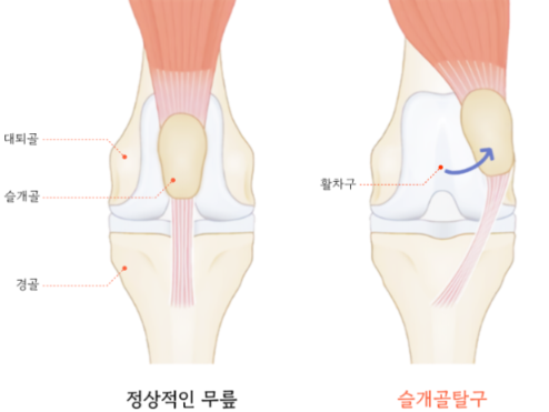 강아지 슬개골 수술비용 300만원⁉️ 1기인데도 당장 수술해야 한다는 말, 진짜일까