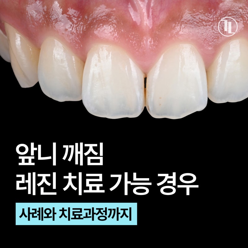 앞니 깨짐 레진치료 가능한 경우 / 레진치료 사례와 과정 / 강남레옹치과